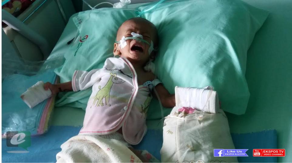 Bocah 1,3 Tahun Penderita Gizi Buruk dan Paru-Paru Ini Butuh Uluran Tangan Dermawan