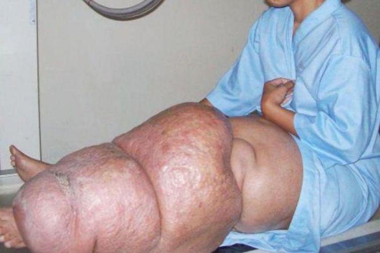 Berobat Kaki Gajah Gratis