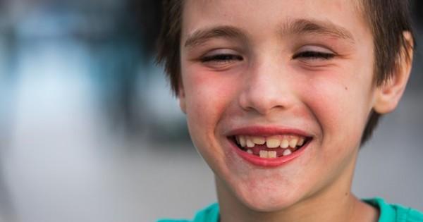 Ini Penyebab dan Cara Mengatasi Gigi Kuning pada Anak