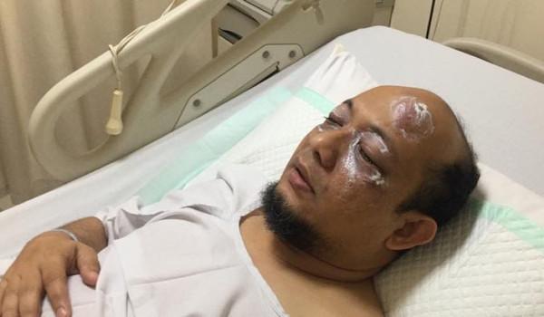 KPK Sebut Kerusakan Mata Novel Baswedan Sangat Parah